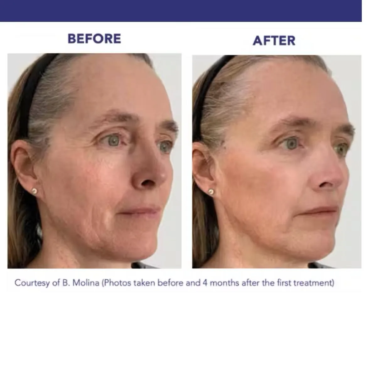 Before and after facial rejuvenation treatment — 4 months after first treatment at Marilux Aesthetics